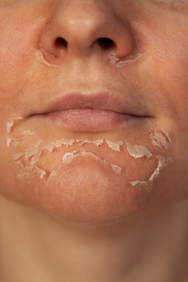 Peeling skin on the face. Woman's face after chemical peeling. Exfoliation of old skin. Medical Chemical Peels