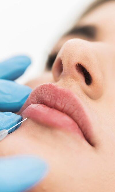 Lip hyaluron filler Hyaluronic Acid Filler