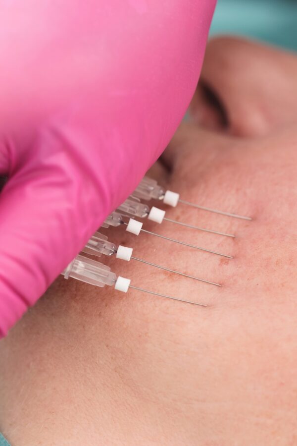 Threadlift Threadlift