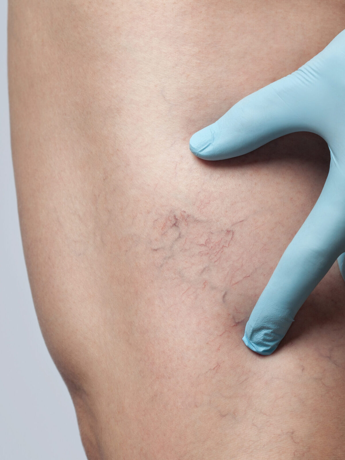 doctor shows the dilation of small blood vessels of the skin on the leg. Medical inspection and treatment of Telangiectasia. The Skin Scholar